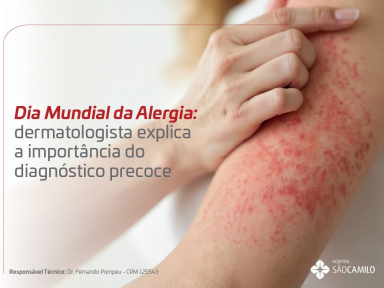 Dia Mundial da Alergia: dermatologista explica a importância do diagnóstico precoce