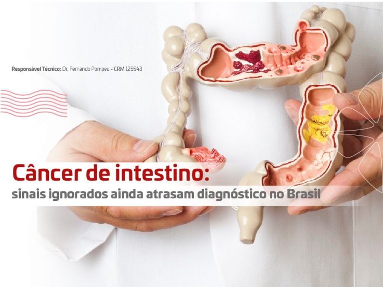 Câncer de intestino: sinais ignorados ainda atrasam diagnóstico no Brasil