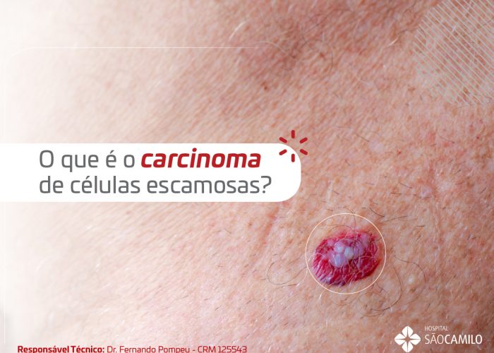 Cancer Carcinoma_Banner