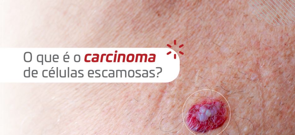 Cancer Carcinoma_Banner