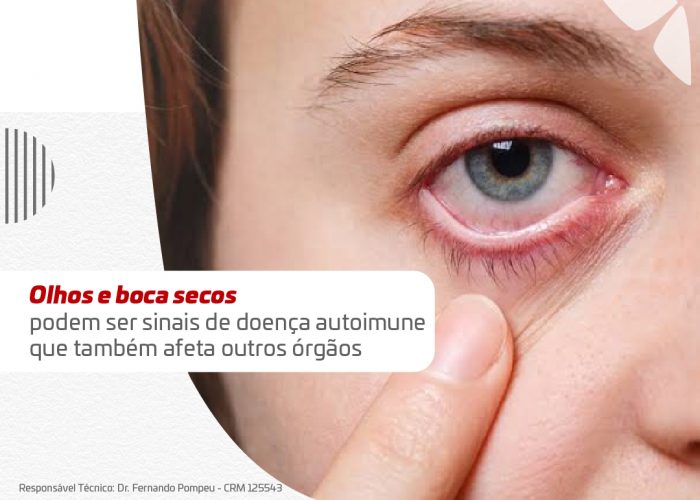 Release - Doença de Sjogren_Banner