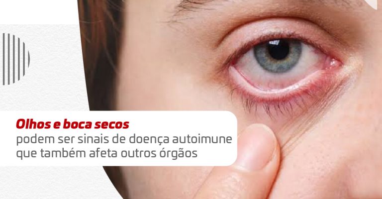 Release - Doença de Sjogren_Banner