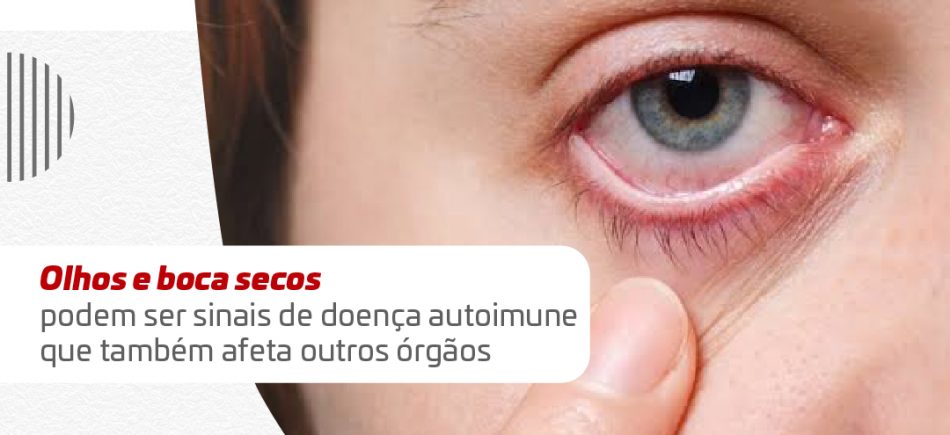 Release - Doença de Sjogren_Banner